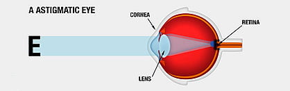 Astigmatism Cherokee