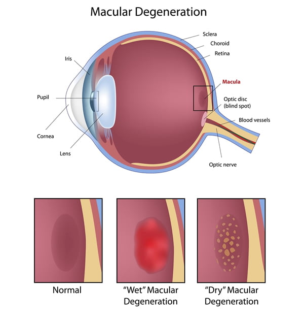 Macular Degeneration Cherokee